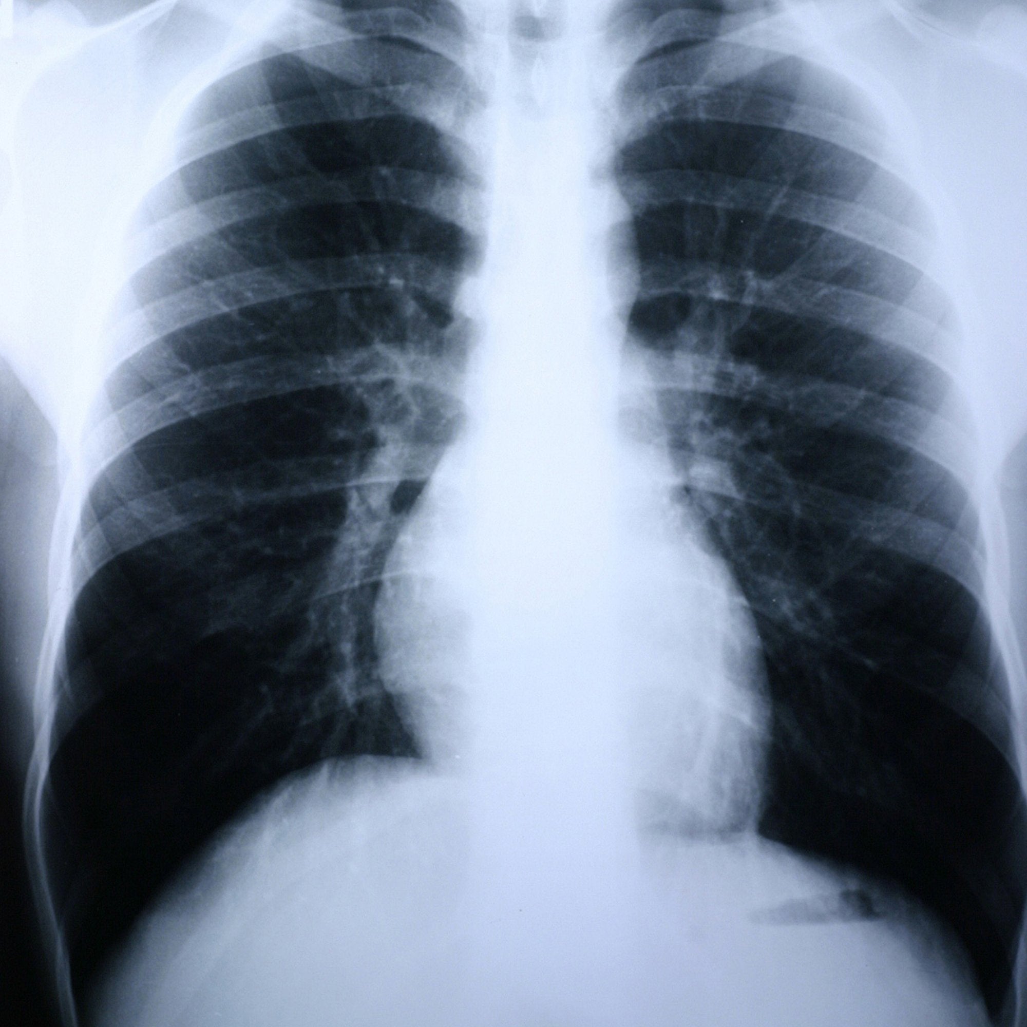 X-Ray Film Clear Choice Performance 8 X 10 Inch Medium Speed Green Sensitive High