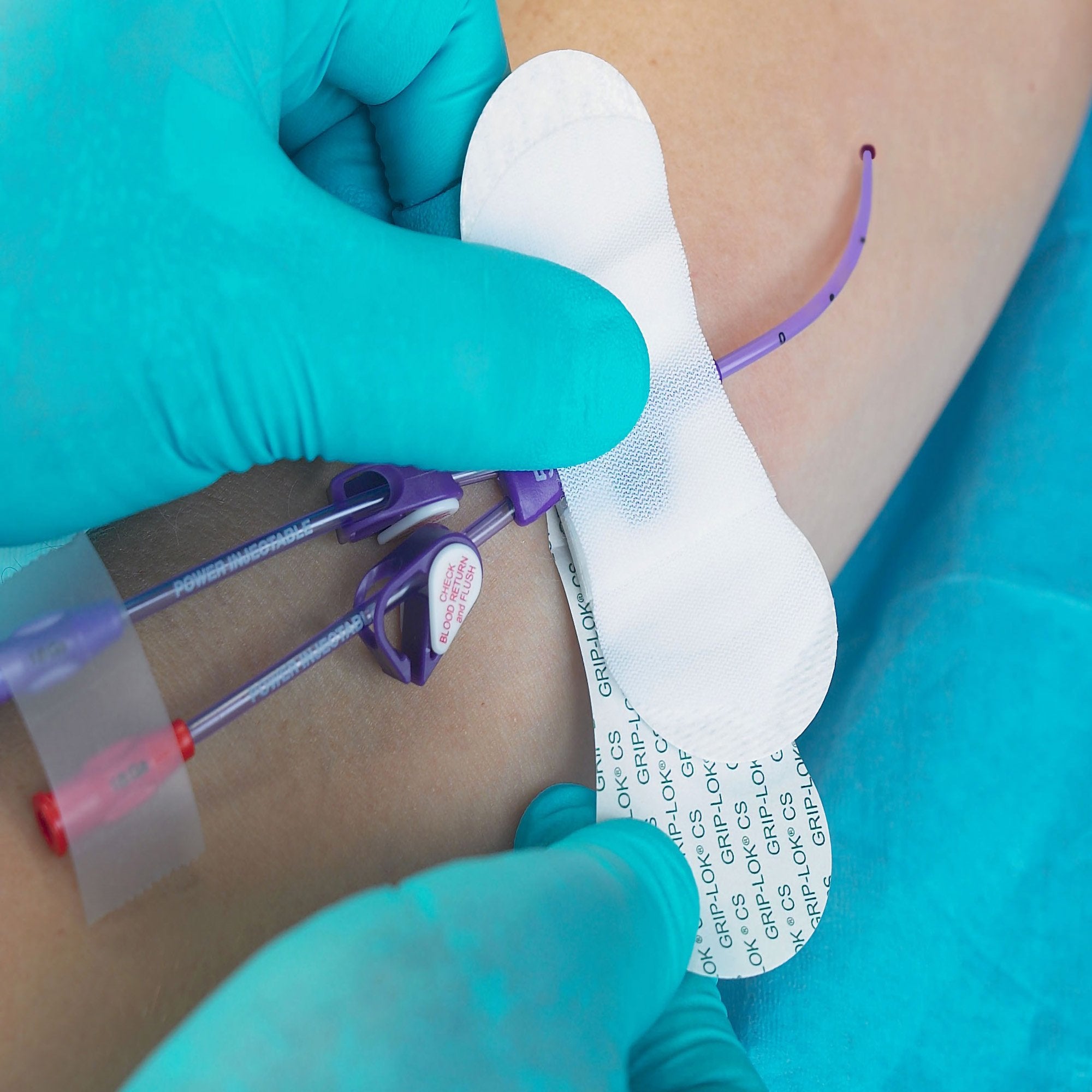Catheter / Line Securement Device Grip-Lok