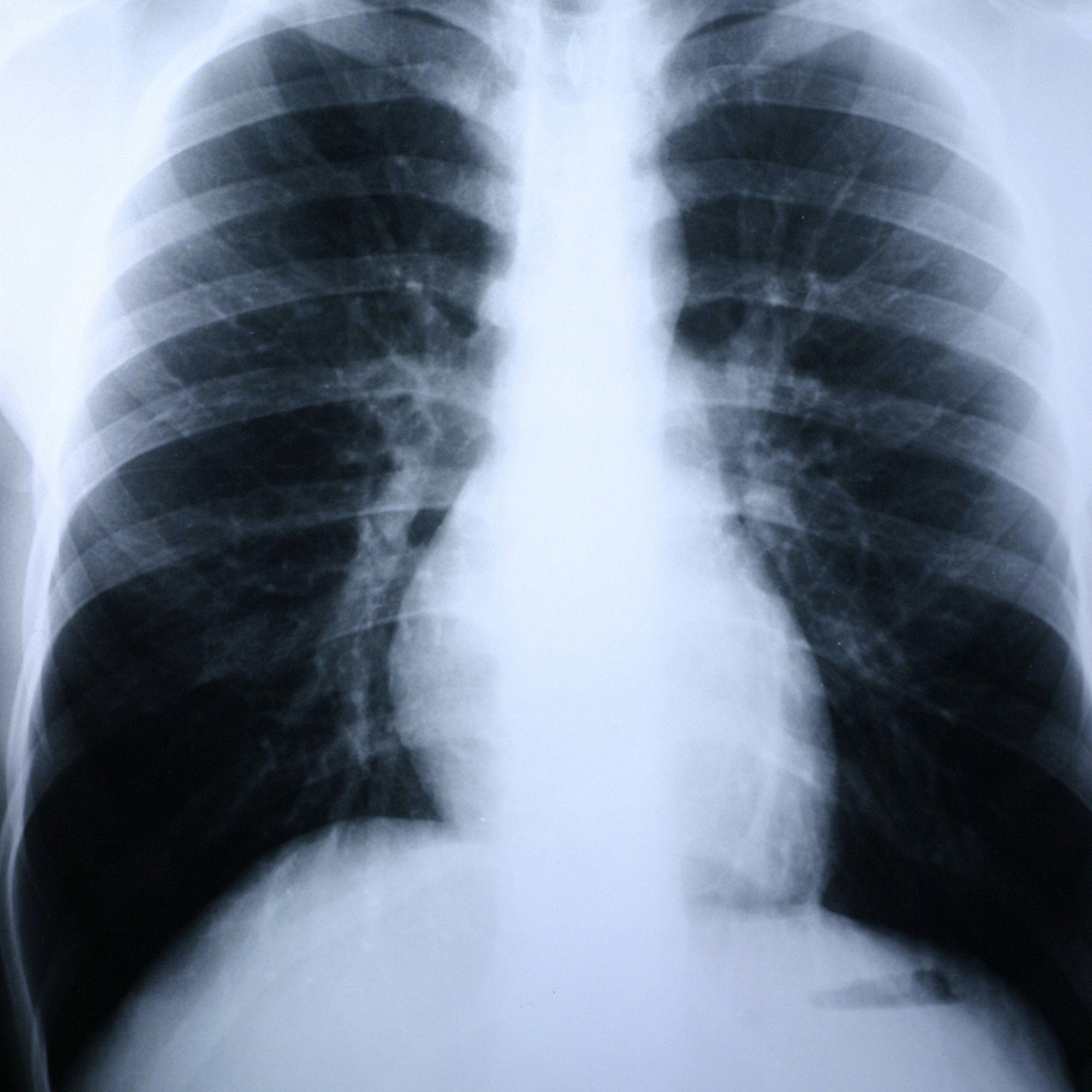 X-Ray Film Clear Choice Performance 8 X 10 Inch High Speed Blue Sensitive High
