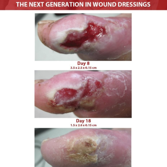 silvrstat silver gel dressing 1 oz silvrstat silver wound gel mk872359ea