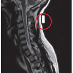 Radiology Skin Marker MRI Spee-D-Mark, Packaging Type- Box