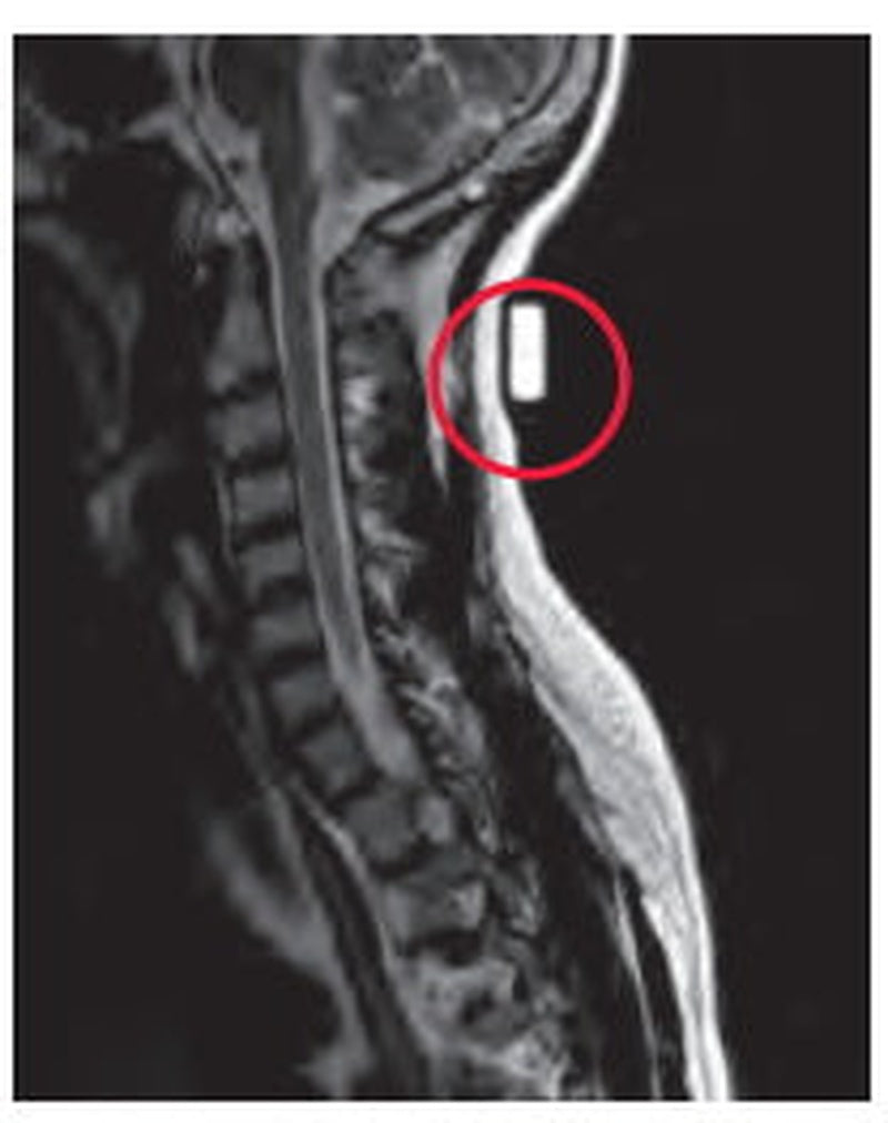 Radiology Skin Marker MRI Spee-D-Mark, Packaging Type- Box