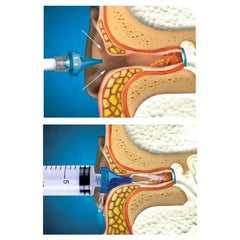 Earwax Removal Syringe