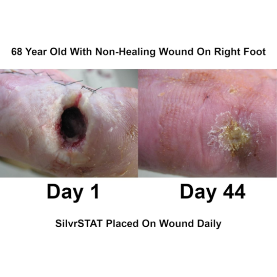 Silver Wound Gel SilvrSTAT NonSterile,Packaging Type- Each