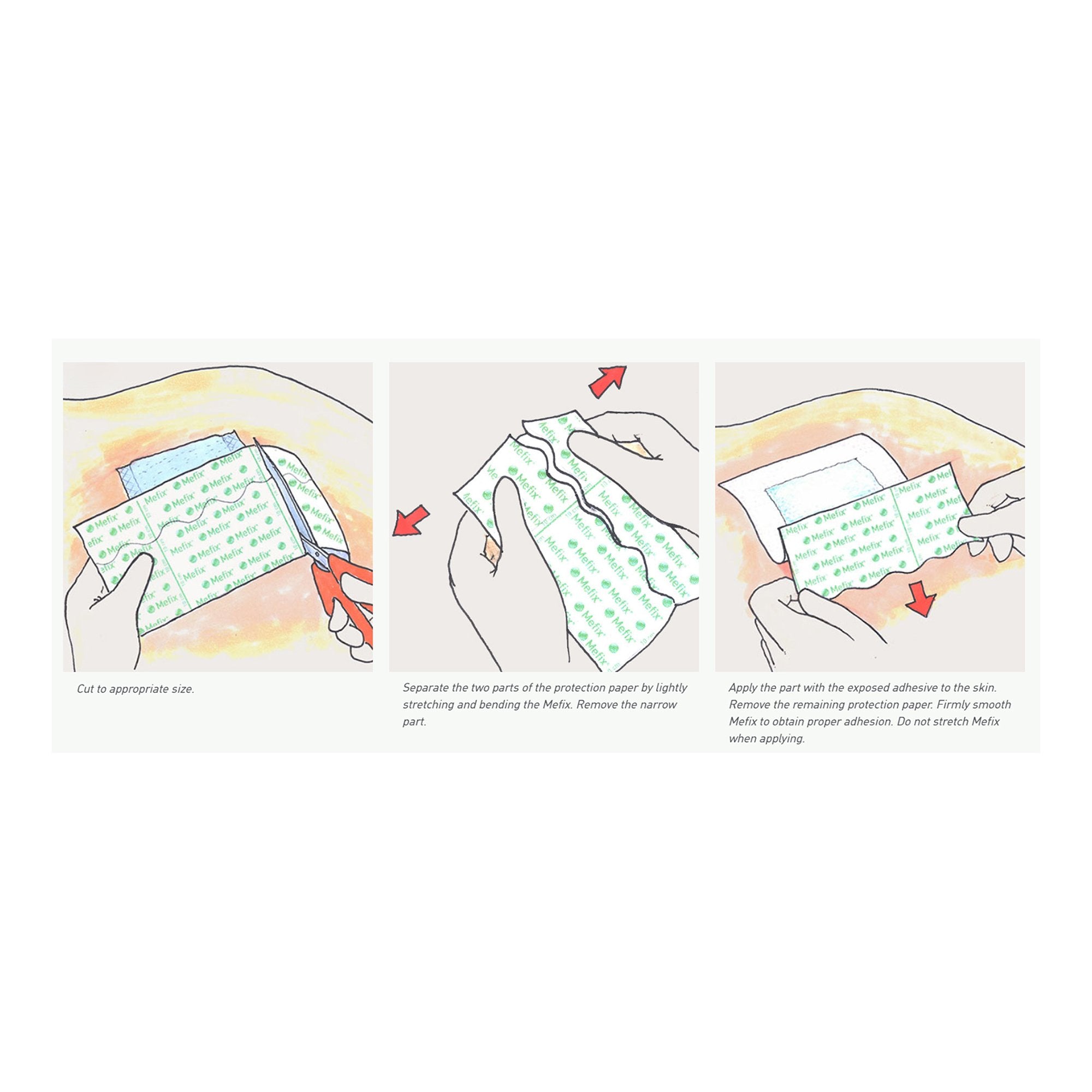 Perforated Dressing Retention Tape with Liner Mefix White 4 Inch X 11 Yard Nonwoven Spunlace Polyester NonSterile,Packaging Type- Box