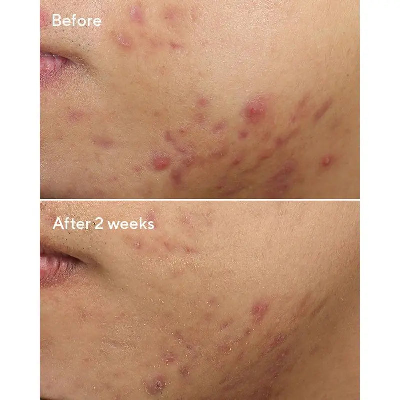 Deep Relief Acne Treatment