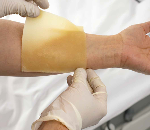 dynasafety xeroburn™ burn dressing