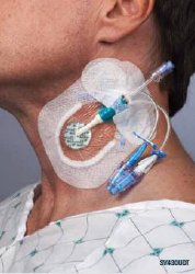 Integrated Securement Dressing Sorbaview SHIELD Fabric / Film 3 3/4 X 4 3/4 Inch Sterile