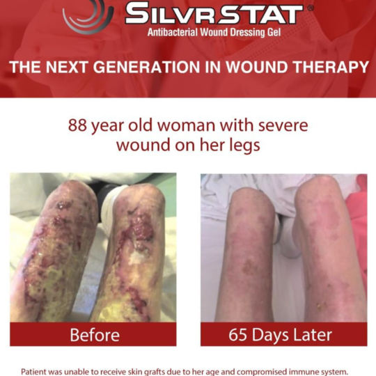 silvrstat silver gel dressing 1 oz silvrstat silver wound gel mk872359ea