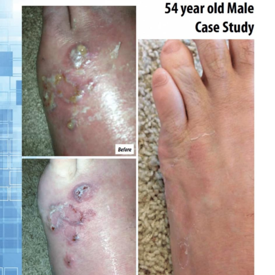 silvrstat silver gel dressing 1 oz silvrstat silver wound gel mk872359ea