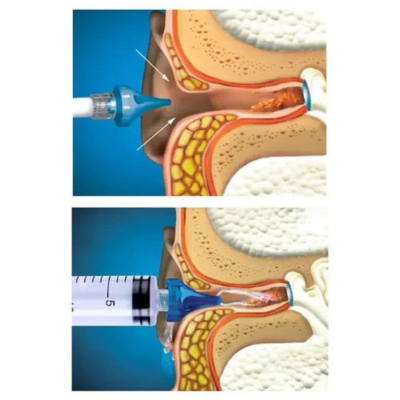 Earwax Removal Syringe