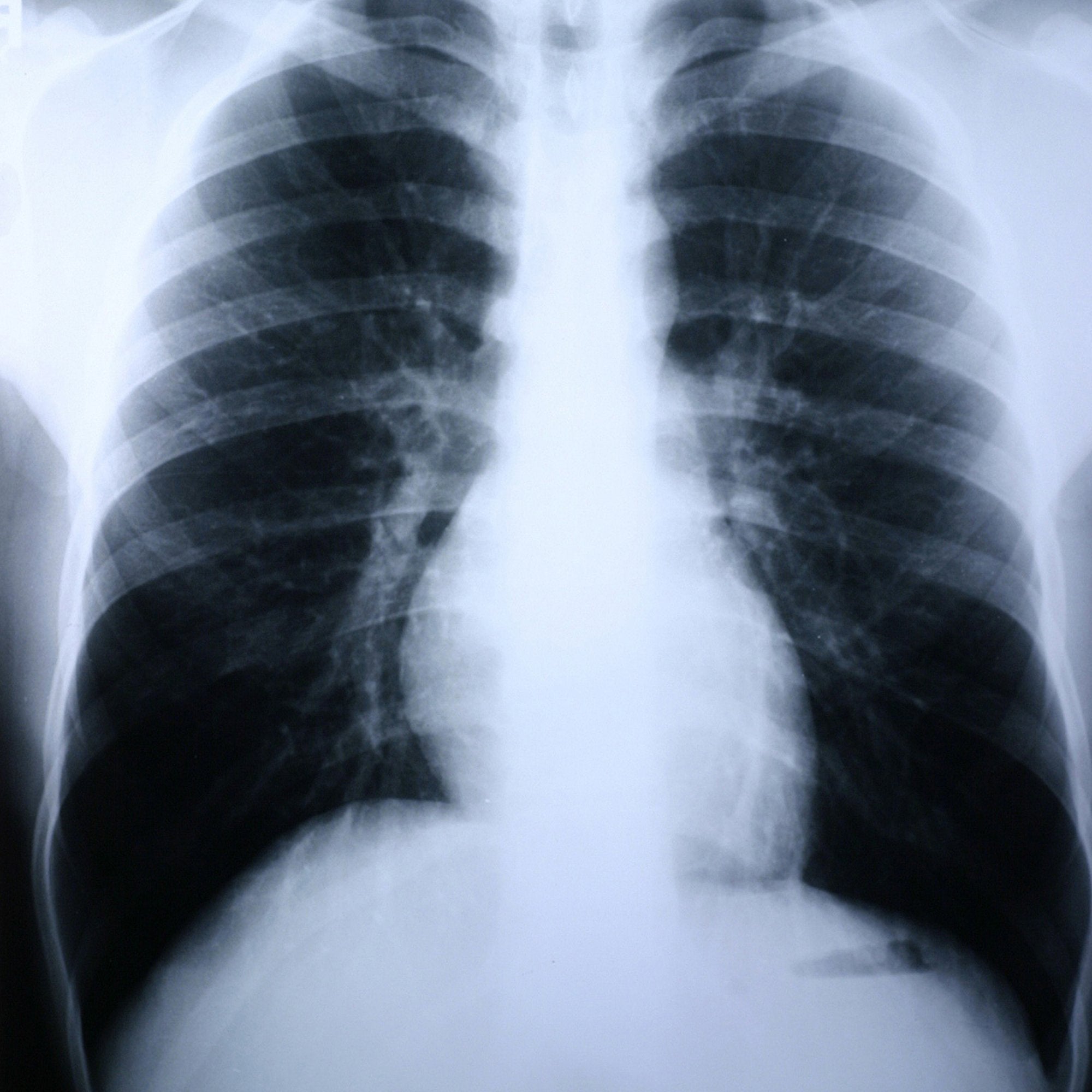 X Ray Film Clear Choice Performance 10 X 12 Inch Medium Speed Green Sensitive High