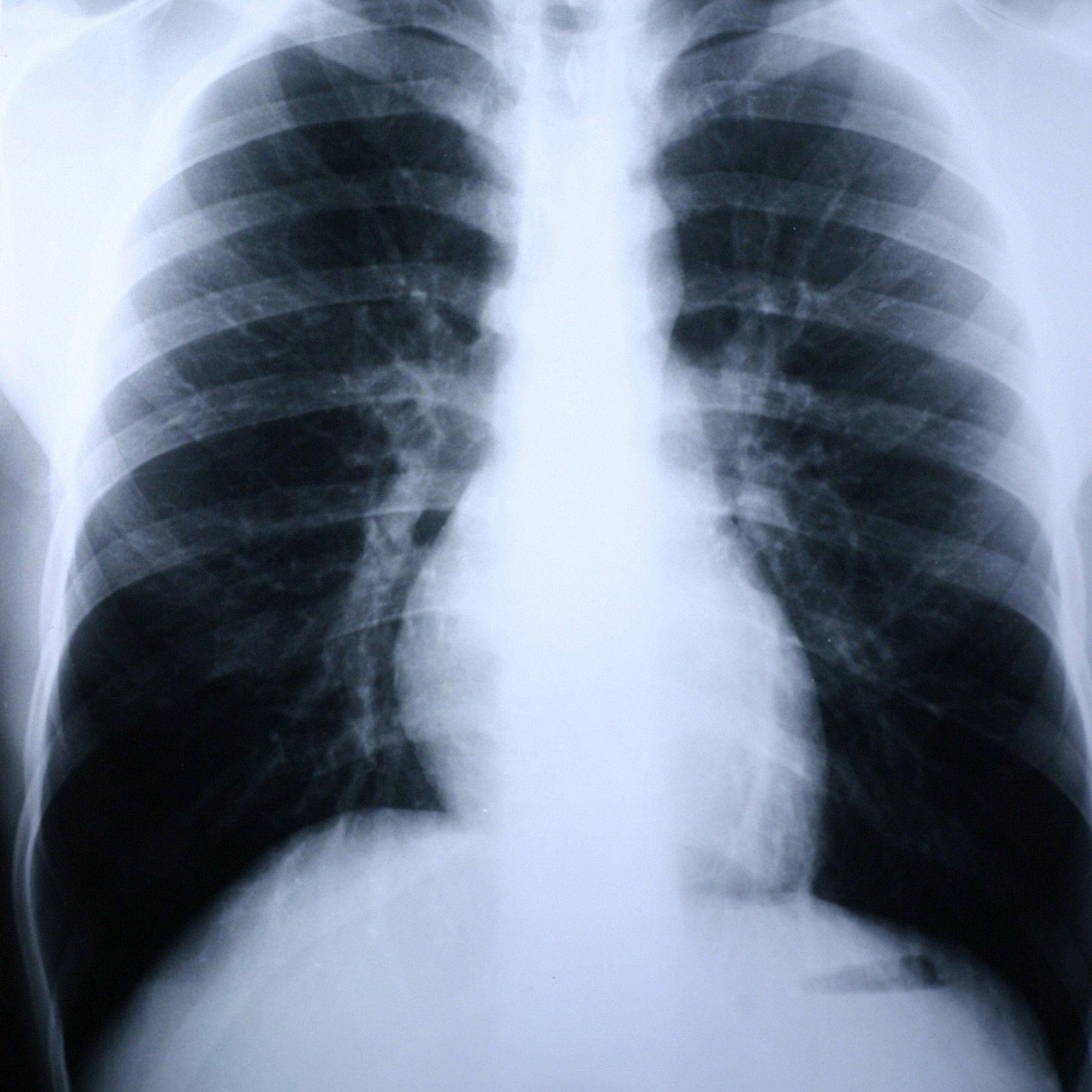 X Ray Film Clear Choice Performance 14 X 17 Inch Medium Speed Green Sensitive High